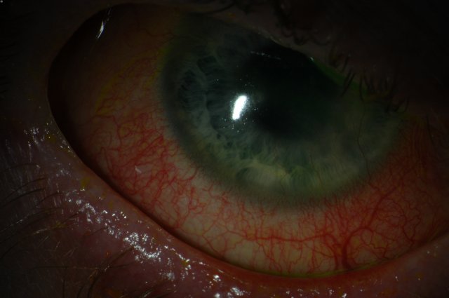Right Eye - 24 year old male who suffered Toxic Epidermal Necrolysis Syndrome with severe Ocular involvement. Photo was taken 2 years after the initial TEN reaction